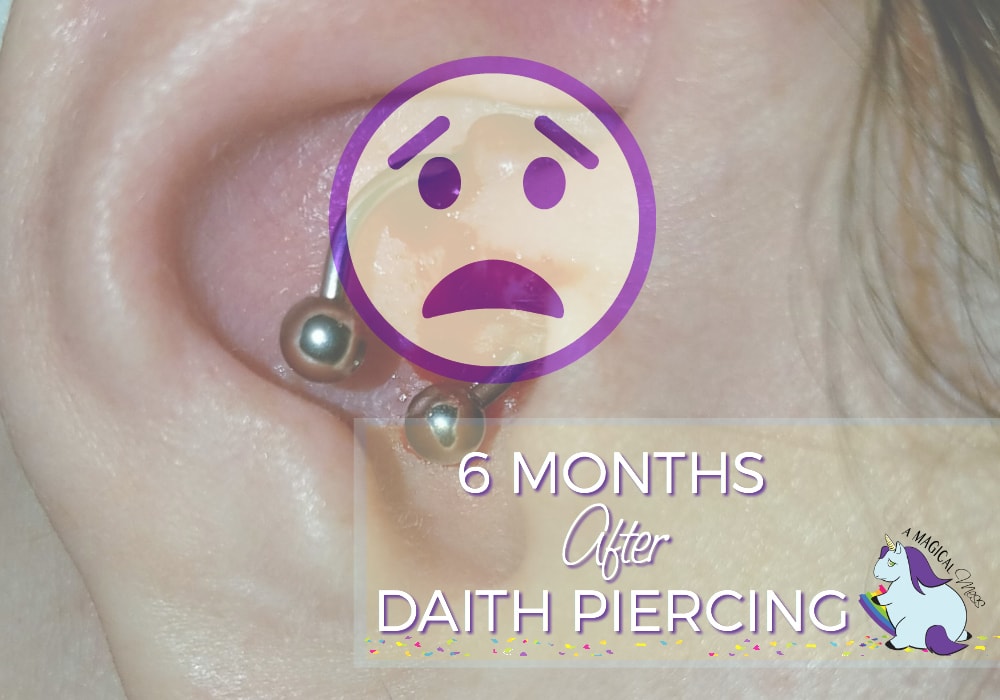 6 Months of results after daith piercing for migraines.