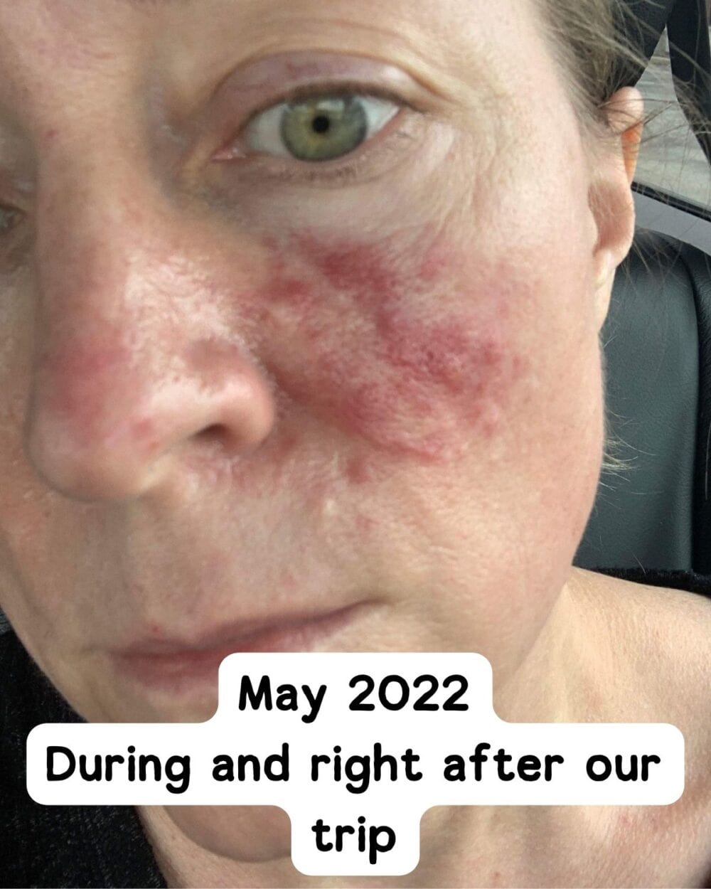 Bad rosacea inflammation on cheek. 