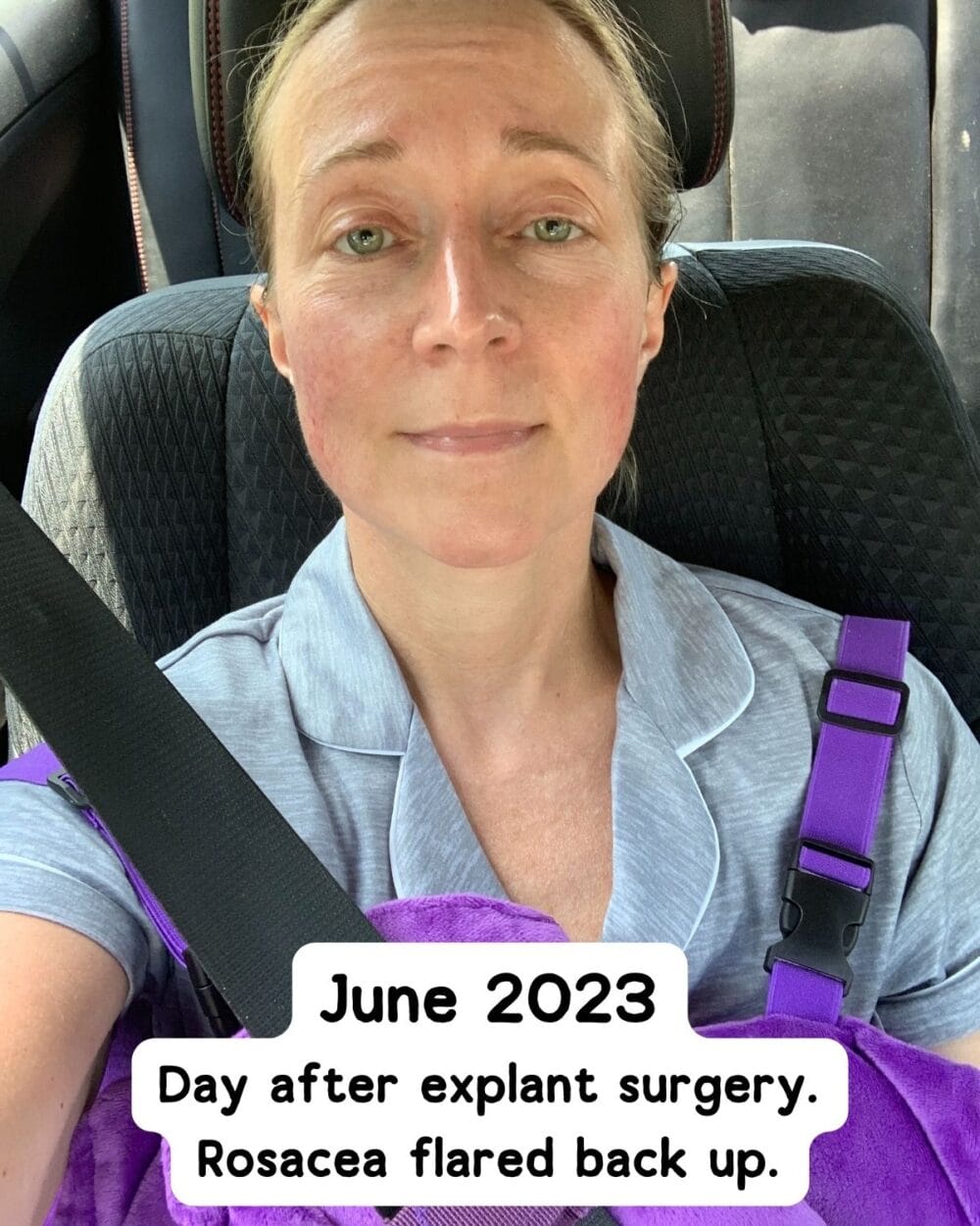 Day after explant surgery which made rosacea flare a bit. 