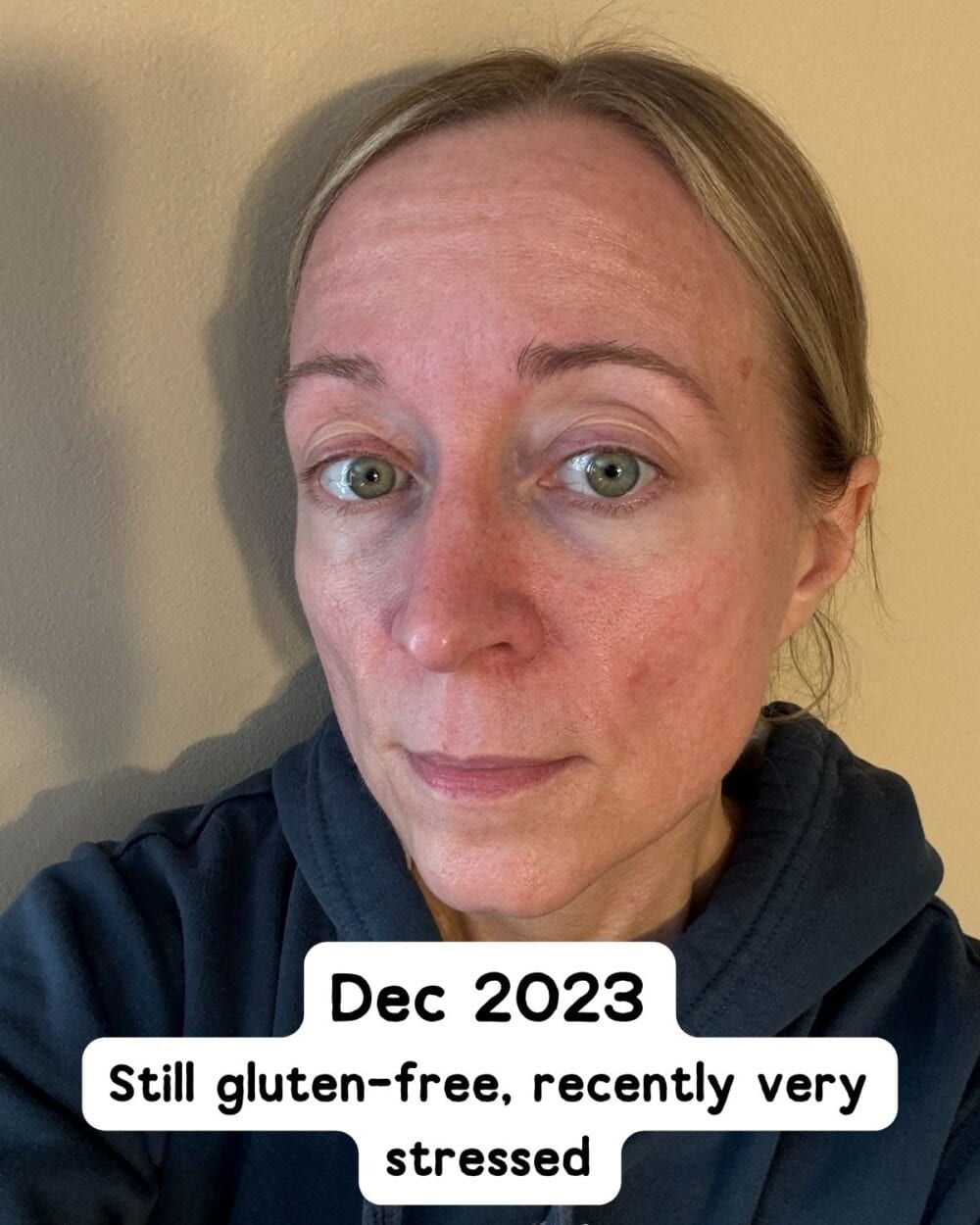 Jen in December showing clearer skin, but a little rosacea flare-up. 
