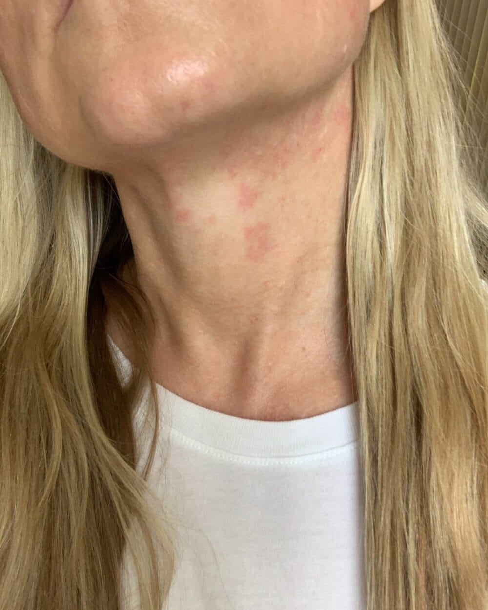 Neck flushed with hives or rosacea due to being nervous.
